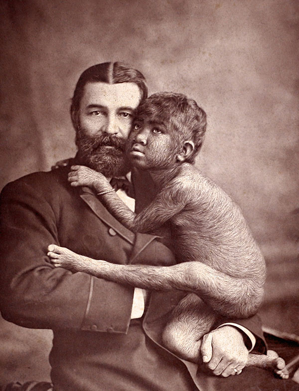 Вильям Леонард Хант с Крао Фарини, родившимся с гипертрихозом (1883 г.)